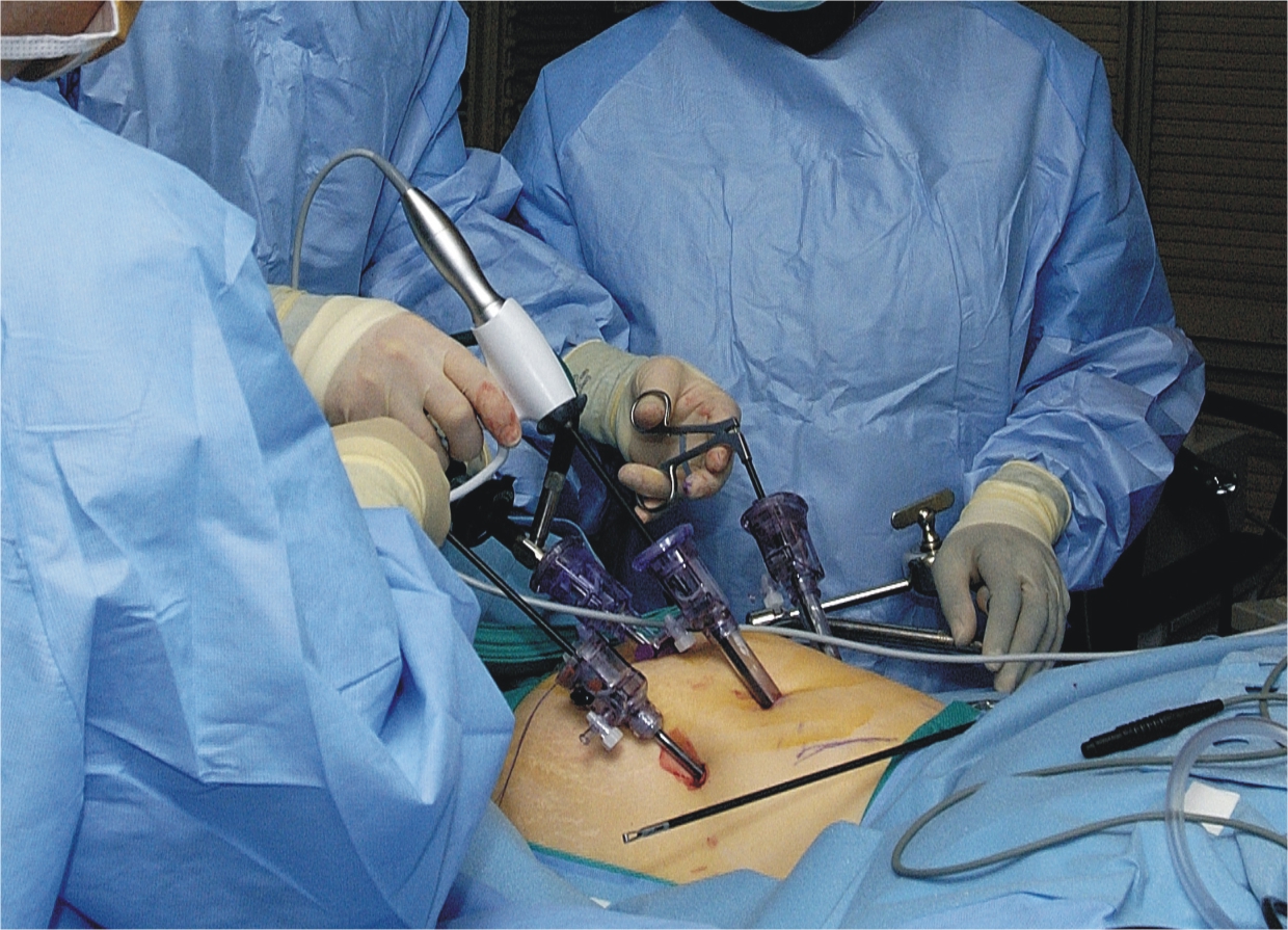  laparoscopic appendectomy 